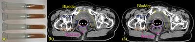 Rectum Protection by Rectal Gel Injection in Cervical Cancer Brachytherapy: A <mark class="highlighted">Dosimetric Study</mark> via Deformable Surface Dose Accumulation and Machine-Learning-Based Discriminative Modeling